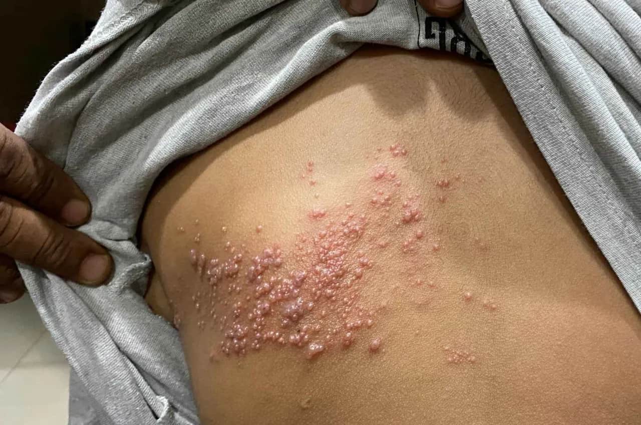 Półpasiec: Jak długo brać leki? 7-10 dni i uniknij neuralgii!