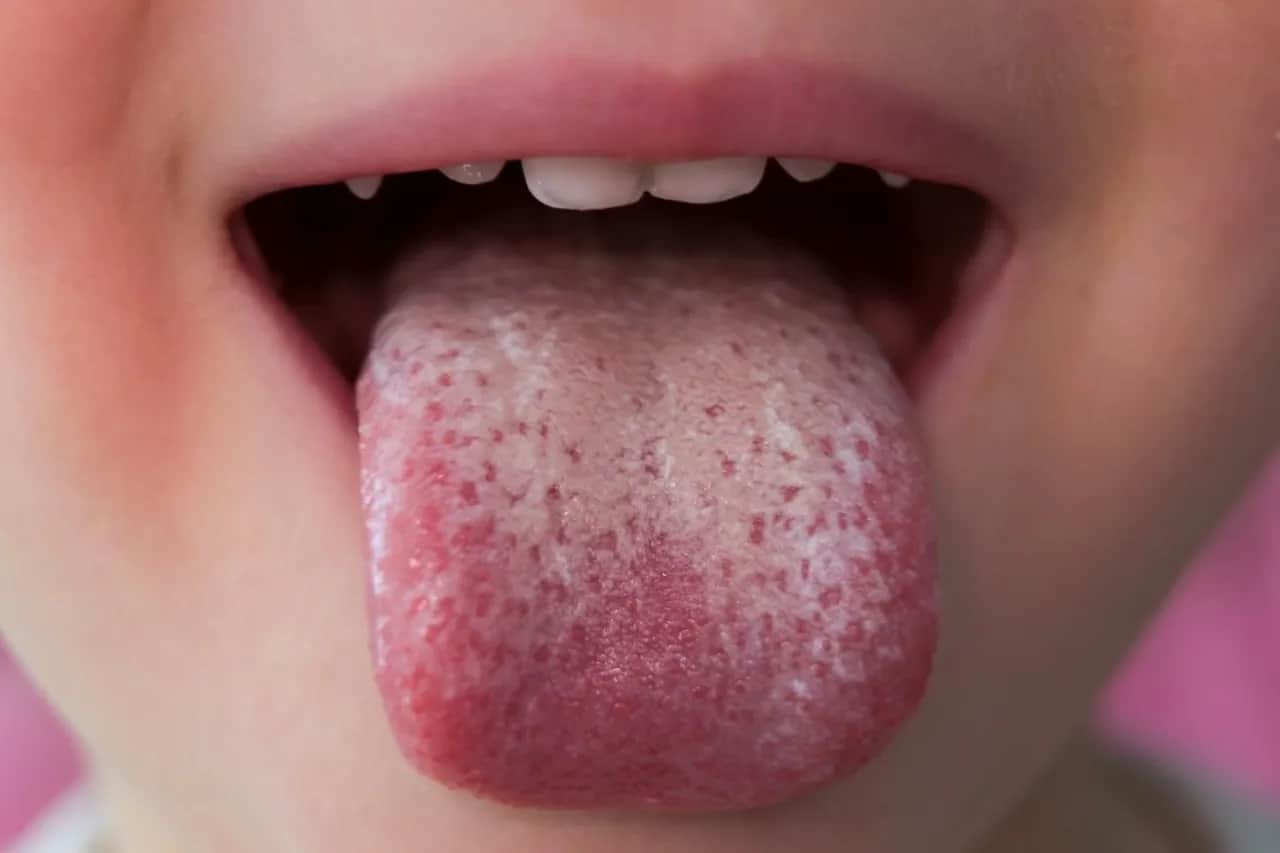 Grzybica języka: Leki OTC, na receptę. Jak uniknąć nawrotów?