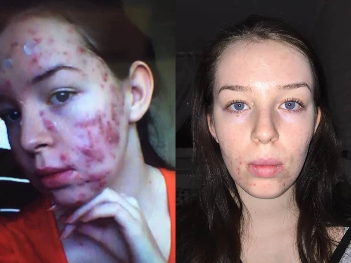 Izotek skutki uboczne: Jak bezpiecznie przejść terapię?