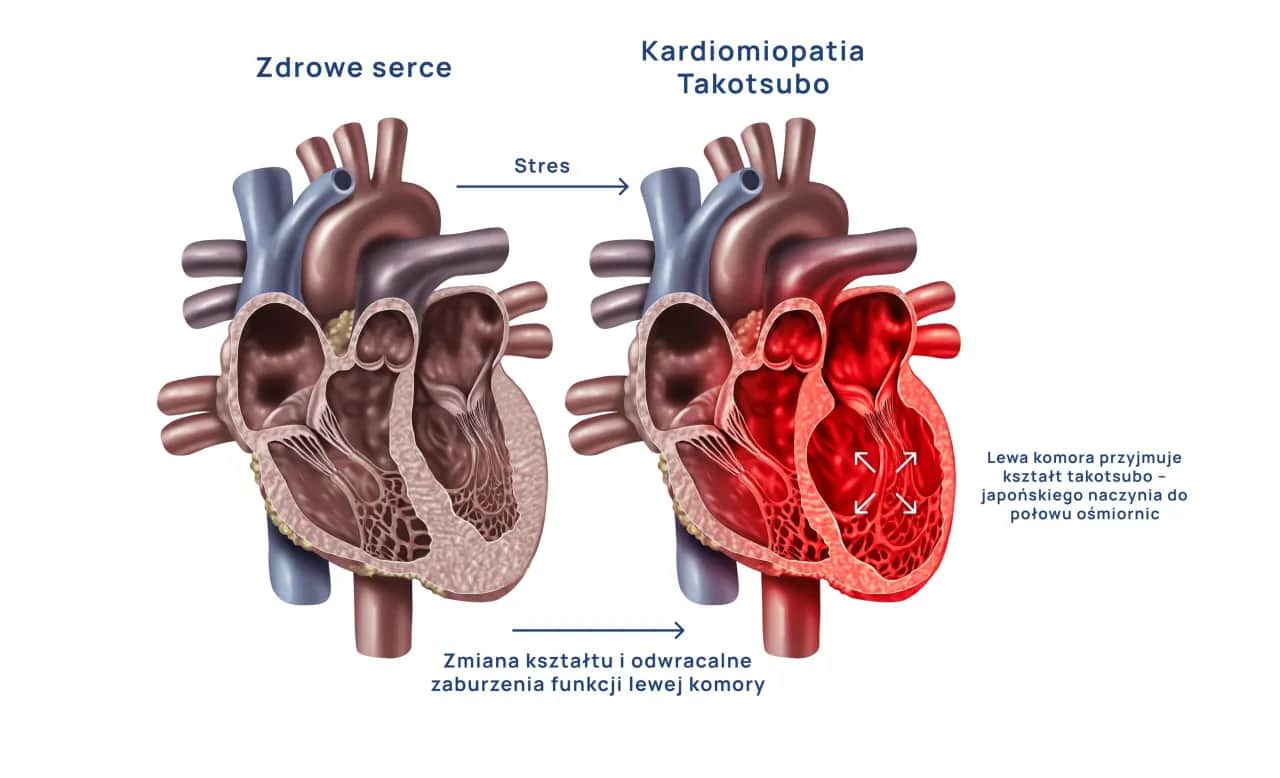 Syndrom złamanego serca: Czy to zawał? Objawy i leczenie